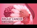5 Signs Of Breast Cancer 3D Animation