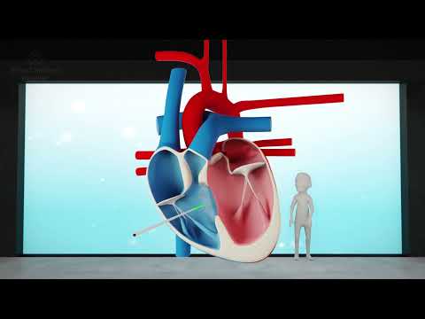 Ventricular Septal Defect (VSD)