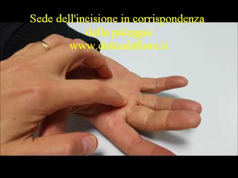 Borsite prepatellyarny delloperazione ginocchio Dolore sul lato destro della testa del collo clavicola