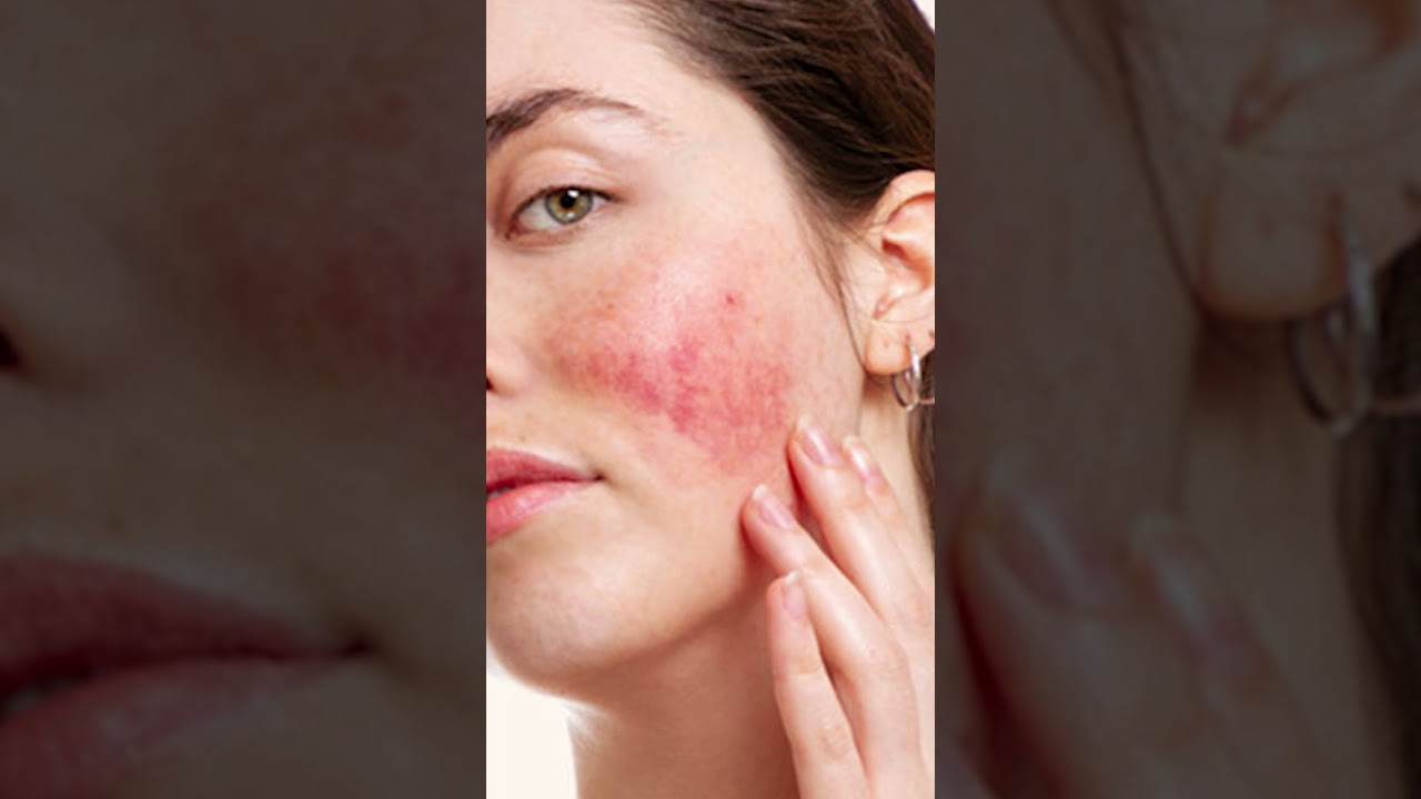 Do potatoes lighten the skin permanently? Tipseri