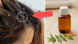 COMO ALIVIAR A COCEIRA NO COURO CABELUDO: 8 MELHORES REMDIOS CASEIROS SURPREENDENTES PARA USAR