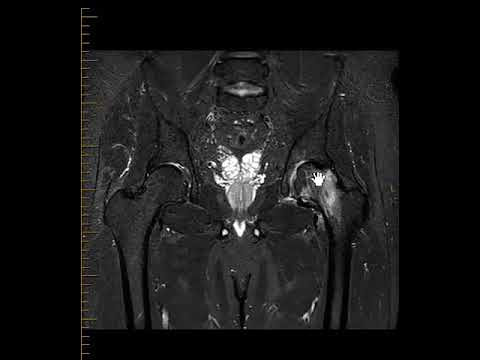 Avascular necrosis (AVN) hip