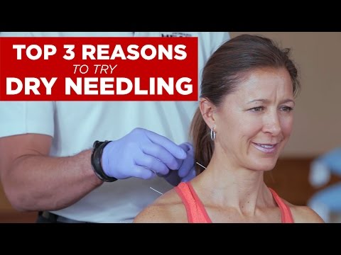Top 3 Reasons to Try Dry Needling