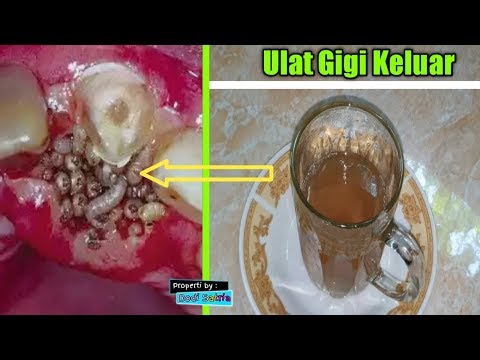 download video viral Cara Ampuh Mengobati Sakit Gigi Hingga Ulatnya Keluar, download Cara Ampuh Mengobati Sakit Gigi Hingga Ulatnya Keluar gratis, unduh video Cara Ampuh Mengobati Sakit Gigi Hingga Ulatnya Keluar