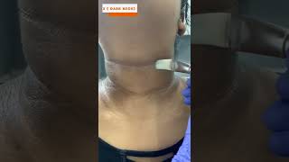Acanthosis nigricans (black neck) at skinaa clinic | Viral #shorts