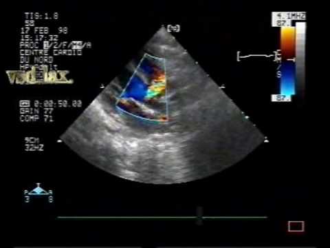 Perimembranous Ventricular Septal Defect (VSD)