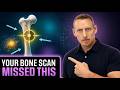 Why Your Bone Density Test Doesn T Tell The Whole Story
