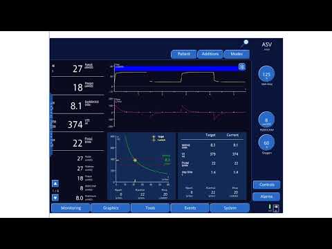 An Overview of Adaptive Support Ventilation (ASV)