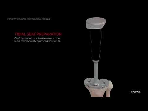Cementless Knee Solutions - Physica System and AMF TT Cones