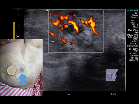 Angiossarcoma, uma rara complicação do tratamento do câncer de mama com radioterapia.