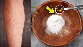 How to treat chigger bites naturally on humans - First Aid Treatment for Chiggers