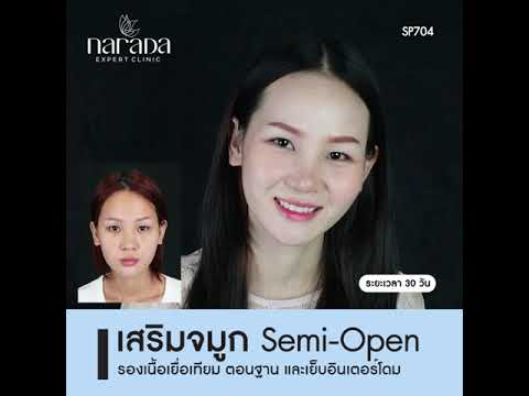 หน้าสวยหวาน มีมิติขึ้นได้ ด้วยการเสริมจมูก เทคนิค Semi-open รองเนื้อเยื่อเทียม ที่ นารดาคลินิก หน้าสวยหวาน มีมิติขึ้นได้ ด้วยการเสริมจมูก เทคนิค Semi-open รองเนื้อเยื่อเทียม ที่ นารดาคลินิก