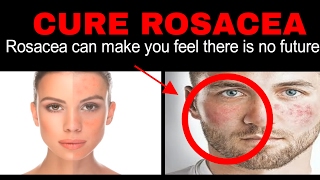 How to Cure Acne Rosacea Overnight! Relief from Adult acne rosacea