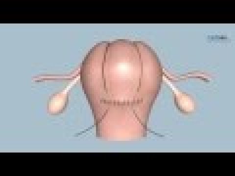 How to perform a B-Lynch Uterine Compression Suture