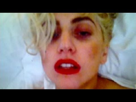 WATCH: Lady Gaga Hit On Head, Suffers Concussion