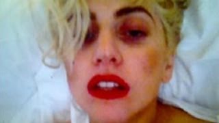WATCH: Lady Gaga Hit On Head, Suffers Concussion