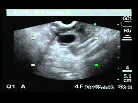 Pancreas - Cystadenoma Mucinous