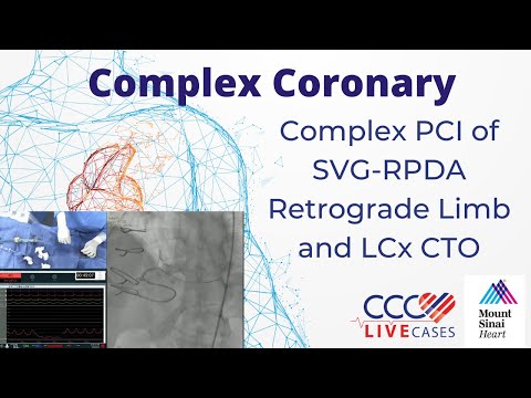 Complex PCI of SVG-RPDA Retrograde Limb and LCx CTO