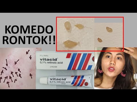 Cara Menghilangkan Komedo Dengan Vitacid, artikel Cara Menghilangkan Komedo Dengan Vitacid gratis, video trending Cara Menghilangkan Komedo Dengan Vitacid