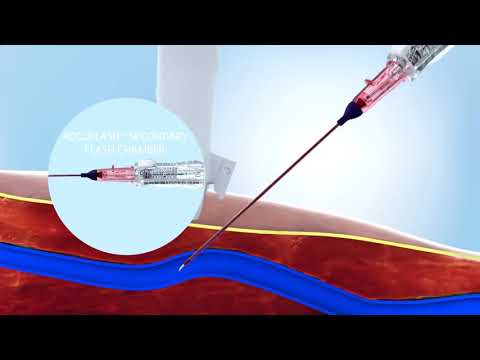 AccuCath™ Ace Intravascular Catheter Insertion Animation