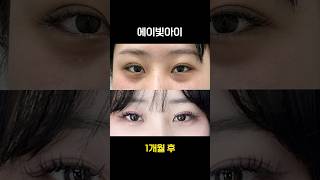 다크써클 시술, 이 시술이 답이었다