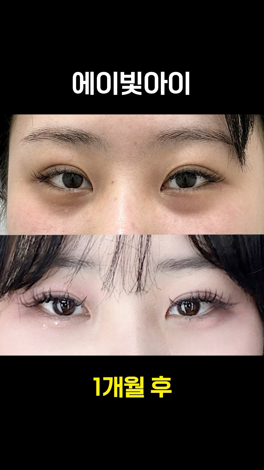 다크써클 시술, 이 시술이 답이었다