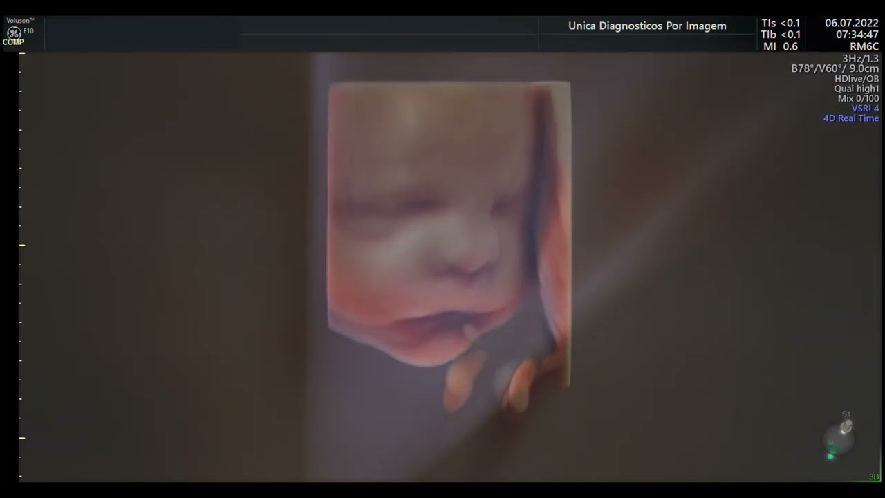 Ultrassom 4D HD Live - 04