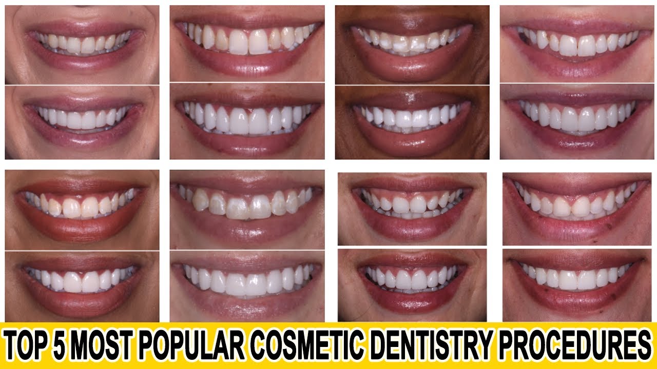 Top 5 Most Popular Cosmetic Dentistry Procedures #shorts #cosmeticdentistry #smilemakeover