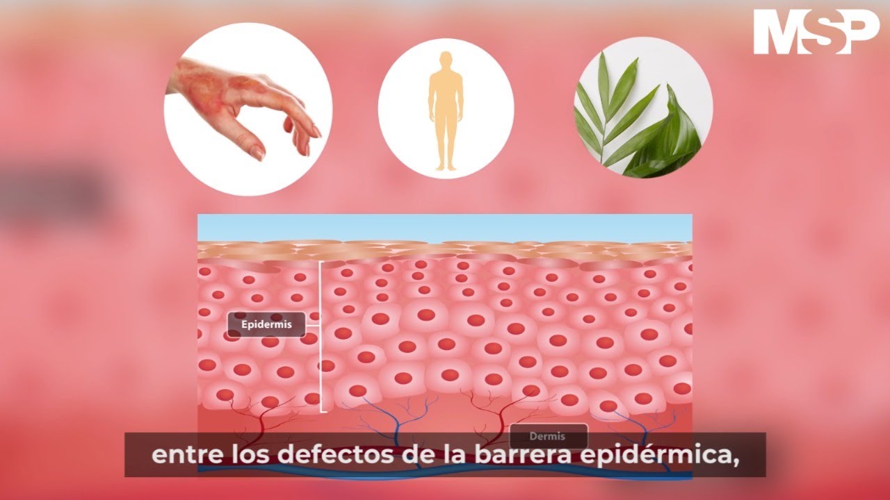 ¿Qué es la dermatitis atópica