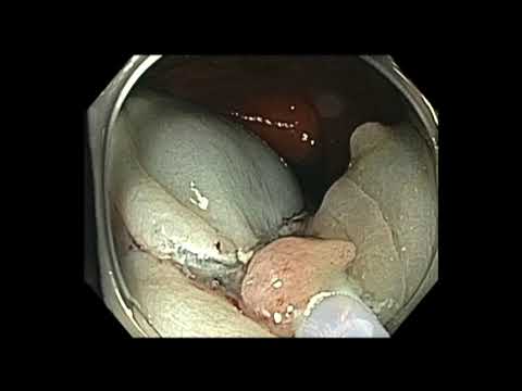 Colonoscopia - pólipo de colon ascendente entre pliegues - RME