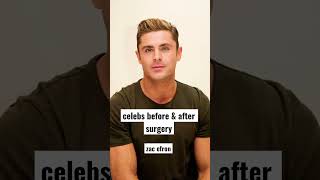 celebs before &amp; after surgery | zac efron