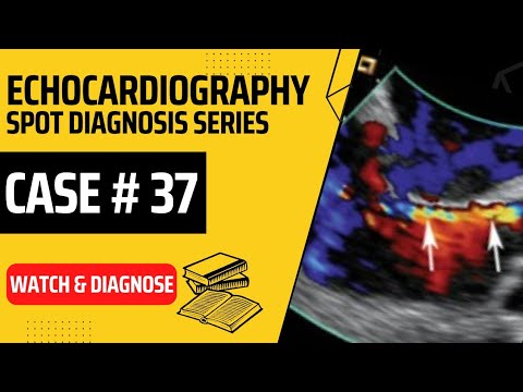 Echo Case 37: Echocardiography Spot Diagnosis Series - Learn Echo with Labelled findings