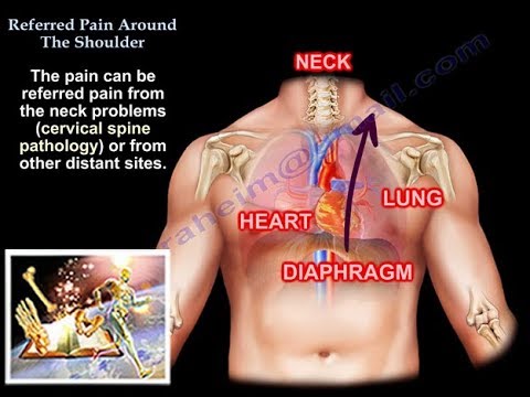 Referred Pain Around The Shoulder - Everything You Need To Know - Dr. Nabil Ebraheim