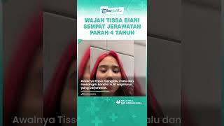 Wajah Sempat Jerawatan Parah Selama 4 Tahun, Tissa Biani Akui Minder hingga Selalu Nangis