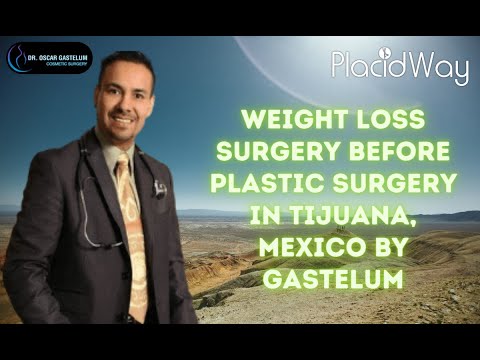 Performing Weight Loss Surgery Before Plastic Surgery in Tijuana, Mexico by Gastelum