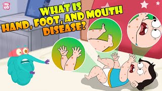 What Is Hand, Foot And Mouth Disease | Infection In Children | The Dr Binocs Show | Peekaboo Kidz