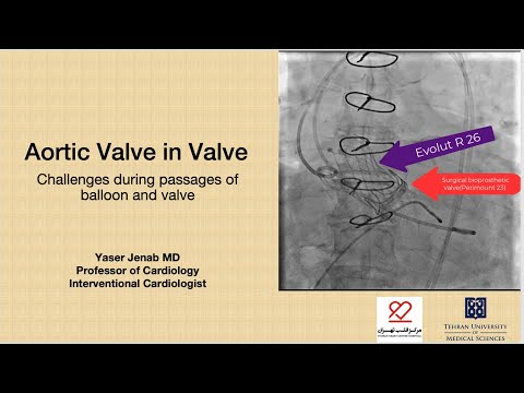 Aortic valve in valve with Evolut R- wire selection