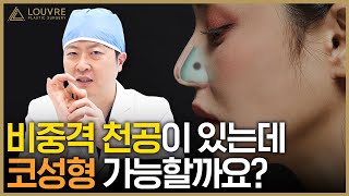 비중격천공 있어도 코성형 가능할까? 천공코 성형, 루브르에서 가능한 이유