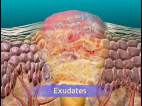 ACUTE INFLAMMATION ANIMATION
