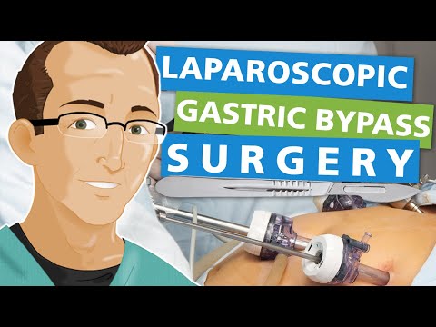 Laparoscopic Gastric Bypass Surgery