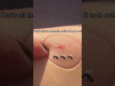 The ultimate solution for mosquito bites #shorts