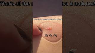 The ultimate solution for mosquito bites #shorts