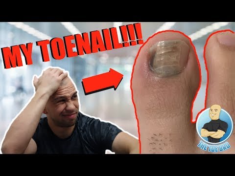 Is the Toe Bro a Wimp? FOOT SPECIALIST CUTTING OWN DAMAGED TOENAIL!!! FOOT HEALTH MONTH 2018 #1 Video