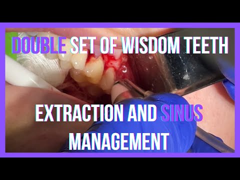 Unusual Case: Extra Wisdom Teeth in Upper Jaw - Surgical Removal and Oroantral Communication Closure