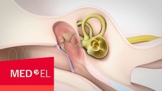 Mixed Hearing Loss Sensorineural and Conductive Hearing Loss | MED-EL