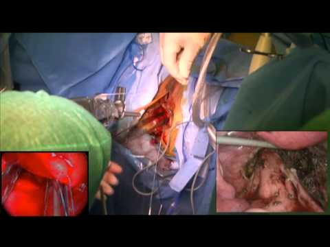 Conservative surgery of large low rectal endometriosis: deep shaving and transanal disc excision