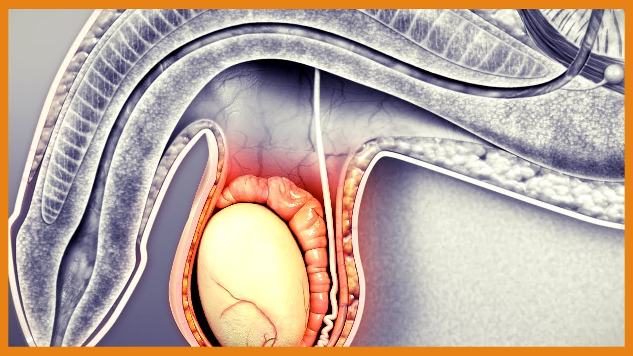 Hydrocele vs. Varicocele vs. Torsion vs. Epididymitis vs. Tumor