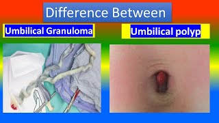 Contrast between Umbilical Granuloma  and Umbilica