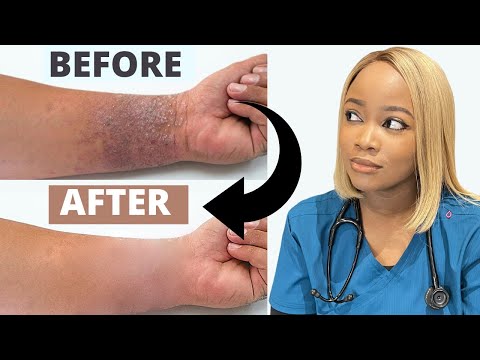 How to Treat ECZEMA | Black Brown skin | Dry Skincare Routine| The #1 Best Remedy for Eczema