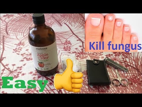 Analogue ekzoderil polish review Paggamot ng kuko halamang-singaw tabako
